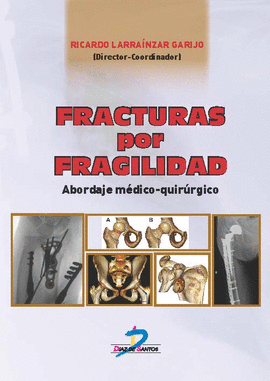 FRACTURA POR FRAGILIDAD