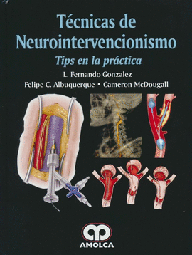 TECNICAS DE NEUROINTERVENCIONISMO TIPS EN LA PRACTICA